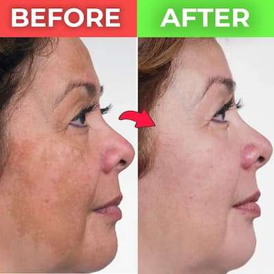 melasma-freckles-pigmentation-treatment (1)